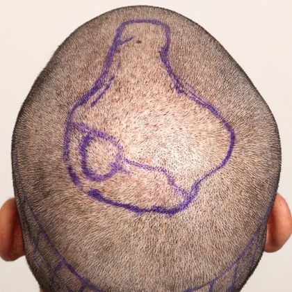 Male Before and After Crown Hair Restoration Photos: Crown (4) - Before FUE hair transplant