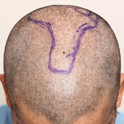 Male Before and After Crown Hair Restoration Photos: Crown (4) - Before FUE hair transplant