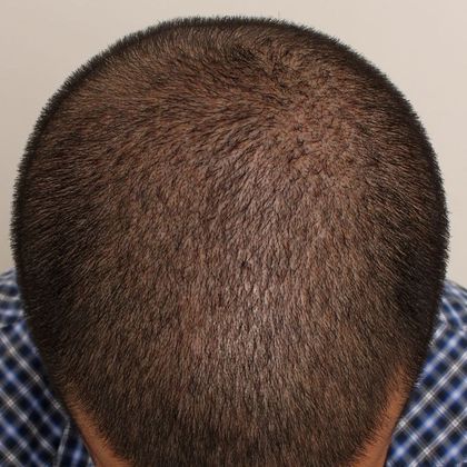 Crown (4) - Male Before and After Crown Hair Restoration Photos ...