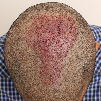 Male Before and After Crown Hair Restoration Photos: Crown (4) - Post-op FUE hair transplant