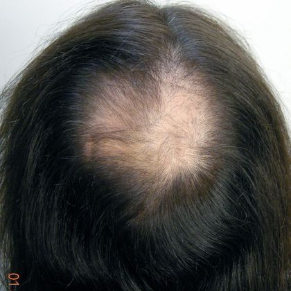 Crown Hair Restoration - Male: Crown (3) - Before FUT