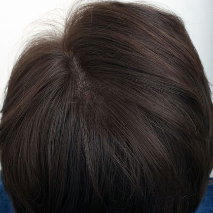 Crown Hair Restoration - Male: Crown (3) - After FUT