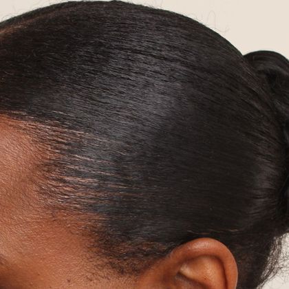 Hair Transplant - Female: Traction Alopecia FUT - After female transplant - styled