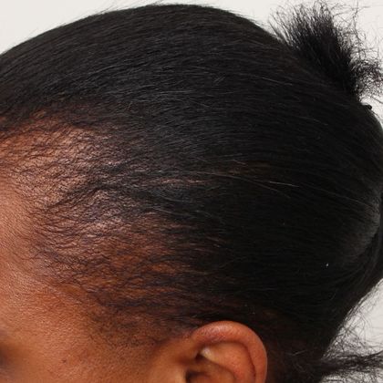 Hair Transplant - Female: Traction Alopecia FUT - Before female transplant