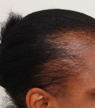 Black Female Hair Transplant - Female Before And After Hair Transplant 