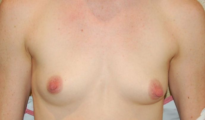 Breast Augmentation Case 784 - Before
