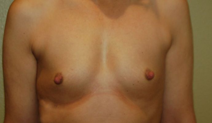 Breast Augmentation: Case 492 - Before