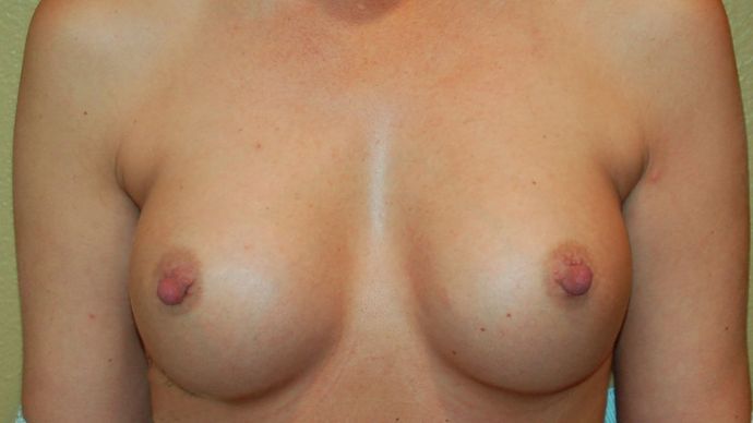 Breast Augmentation: Case 492 - After