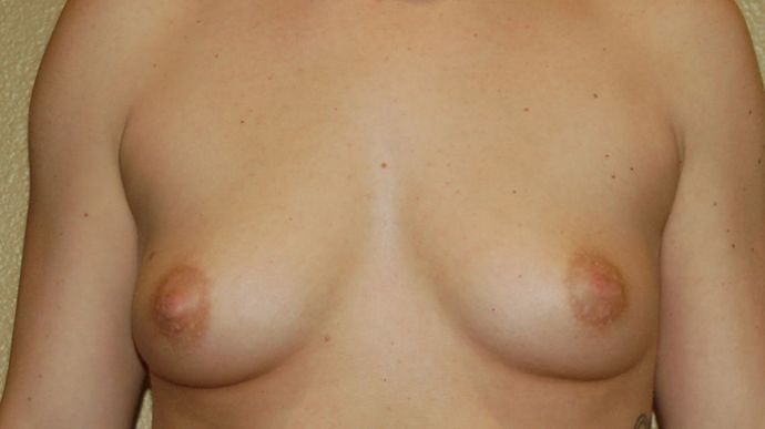 Breast Augmentation Case 502 - Before