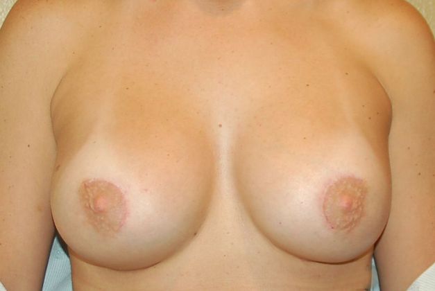 Breast Augmentation Case 502 - After