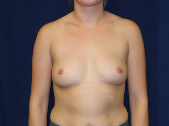 Breast Augmentation*: Case 37 - Before