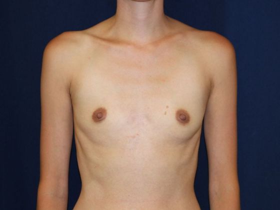 Breast Augmentation*: Case 46 - Before