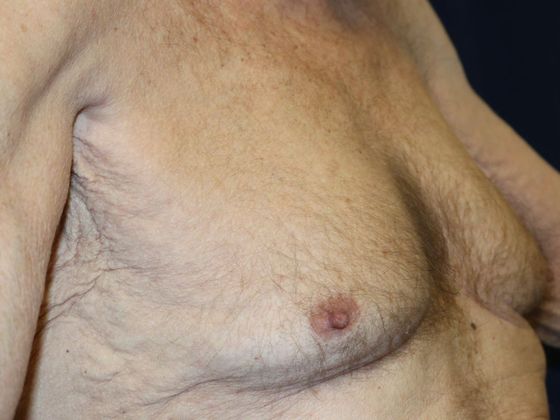 Liposuction & Safe Lipo: Case 17 - Before