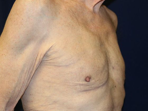 Liposuction & Safe Lipo: Case 17 - After