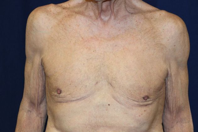 Liposuction & Safe Lipo: Case 17 - After