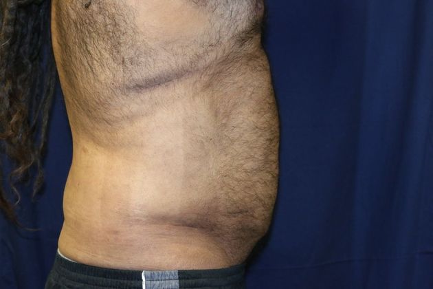 Liposuction & Safe Lipo: Case 18 - After