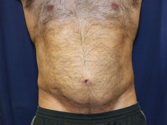 Liposuction & Safe Lipo Case 18 - After