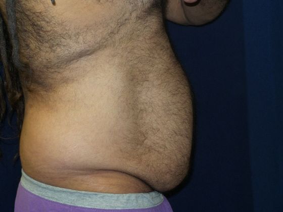 Liposuction & Safe Lipo: Case 18 - Before