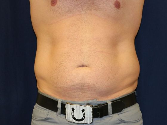 Liposuction & Safe Lipo: Case 19 - Before