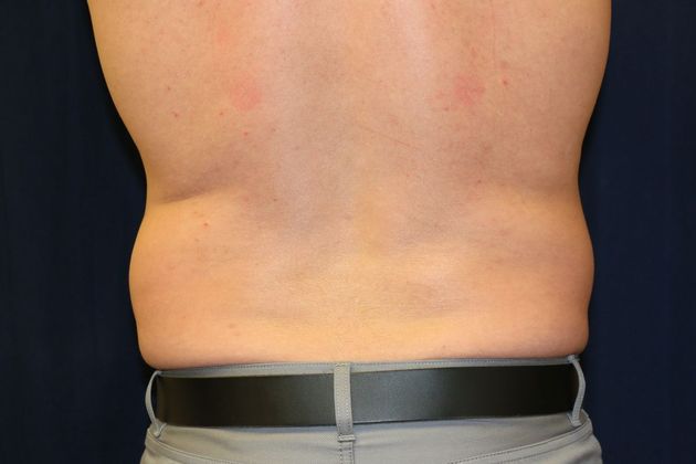 Liposuction & Safe Lipo: Case 19 - Before