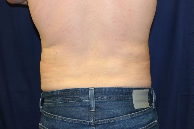 Liposuction & Safe Lipo: Case 19 - After