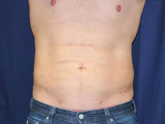 Liposuction & Safe Lipo: Case 19 - After