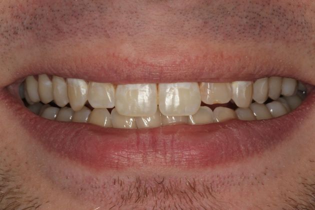 Cosmetic Dentistry Mottled Tooth Enamel - Before