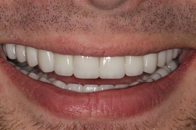 Cosmetic Dentistry Mottled Tooth Enamel - After