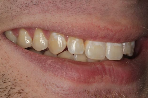 Cosmetic Dentistry: Mottled Tooth Enamel - Before