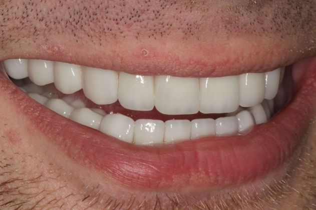 Cosmetic Dentistry: Mottled Tooth Enamel - After