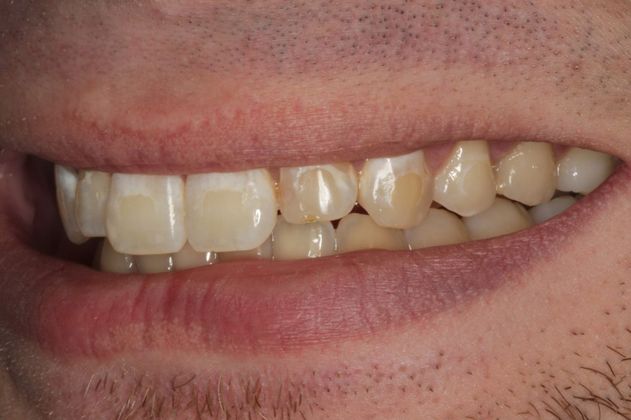 Cosmetic Dentistry: Mottled Tooth Enamel - Before