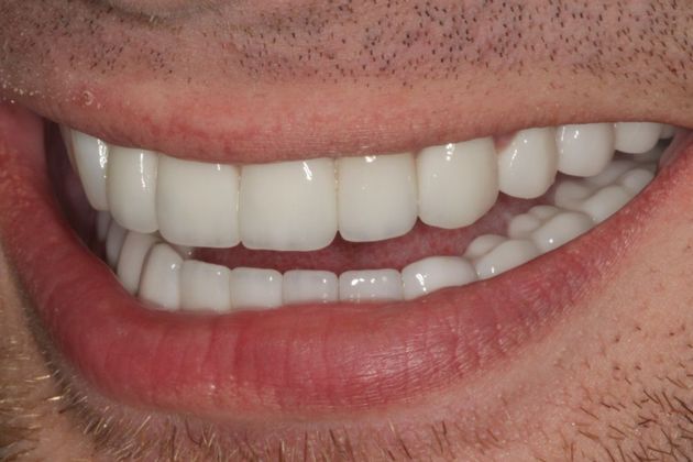 Cosmetic Dentistry: Mottled Tooth Enamel - After
