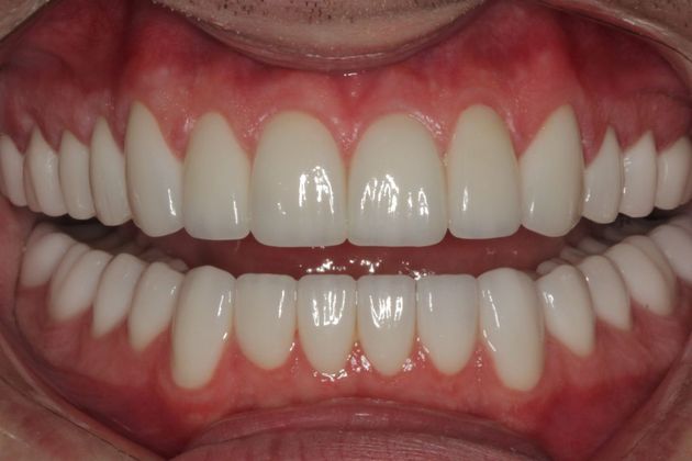 Cosmetic Dentistry: Mottled Tooth Enamel - After
