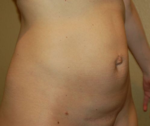 Tummy Tuck (Abdominoplasty): Case 144 - Before
