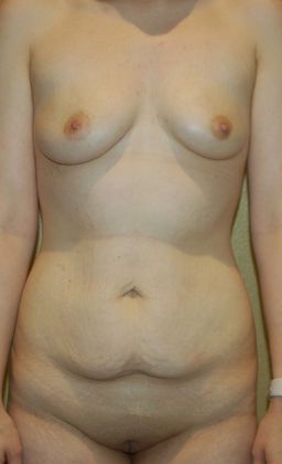 Mommy Makeover Case 103 - Before