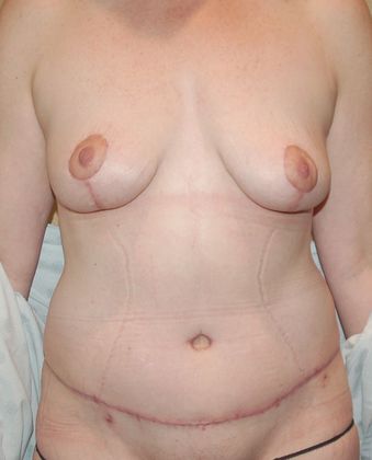 Massive Weight Loss : Case 47 - After