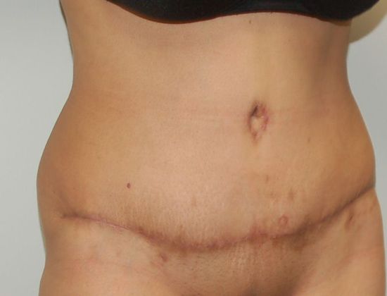 Tummy Tuck (Abdominoplasty) Case 149 - After
