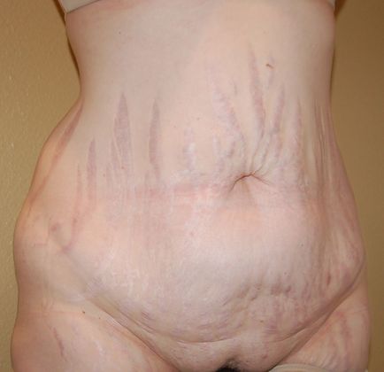 Tummy Tuck (Abdominoplasty): Case 151 - Before