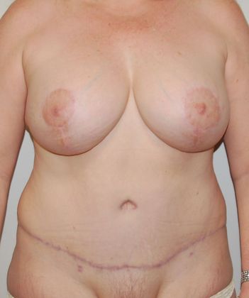 Mommy Makeover Case 106 - After