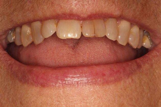 Cerec One Visit Crowns: Case 1 - Cerec Crown on a Single Front Tooth - Before