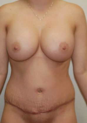 Mommy Makeover Case 107 - After