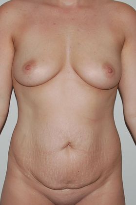 Mommy Makeover Case 107 - Before
