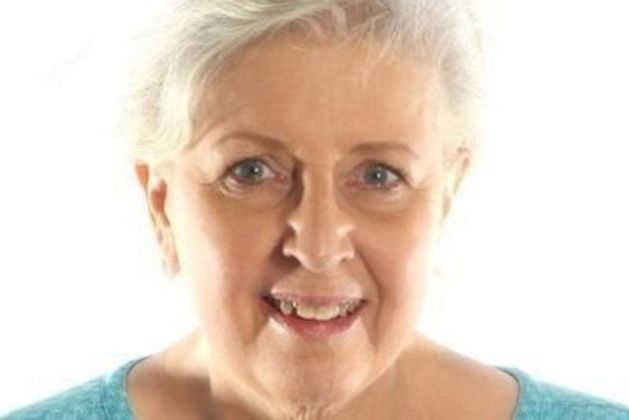 All on 4 Dental Implants Case 10  - Before