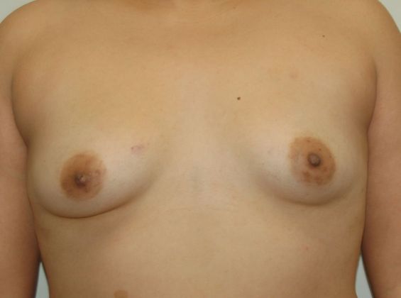 Breast Augmentation Case 509 - Before