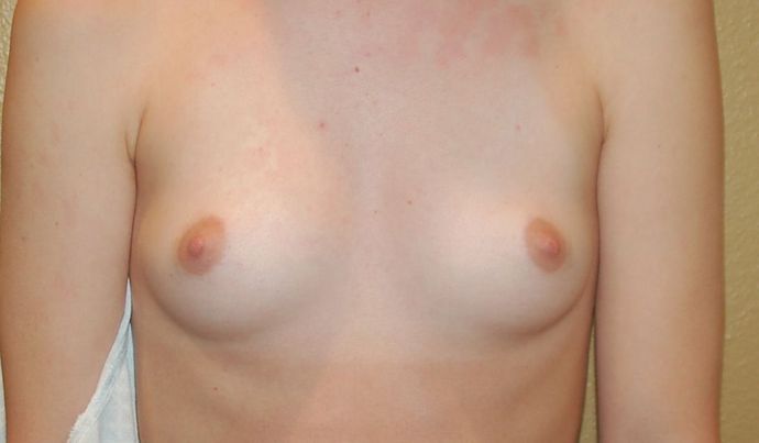 Breast Augmentation Case 511 - Before