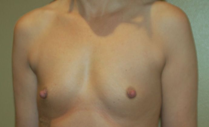 Breast Augmentation: Case 515 - Before