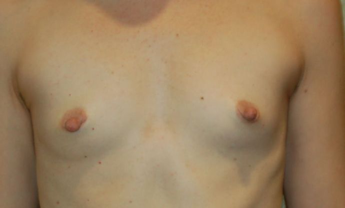 Breast Augmentation Case 516 - Before