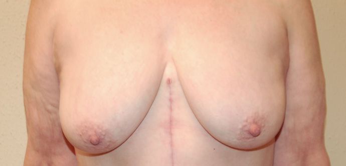Breast Lift (Mastopexy) Case 55 - Before