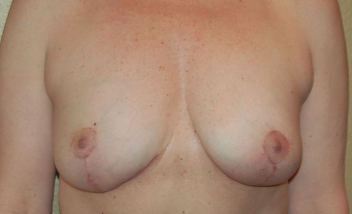 Breast Lift (Mastopexy) Case 56 - After