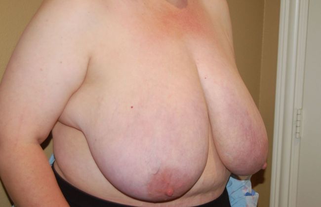 Breast Reduction: Case 56 - Before